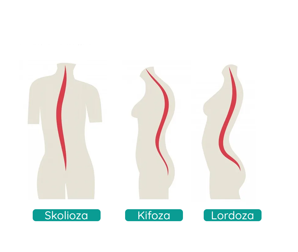 Skolioza, kifoza, lordoza kicme kod dece - Prime Medical Kids