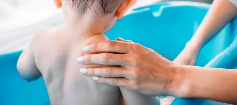 Ekcem kod dece - uzroci, simptomi, lecenje