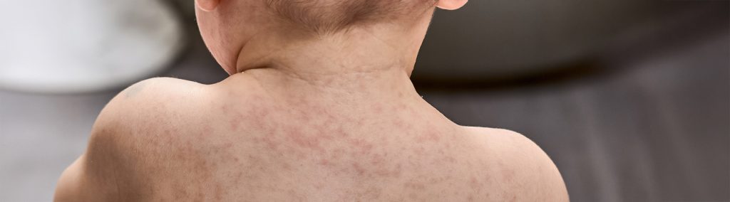 Roseola kod dece - Prime Medical Kids