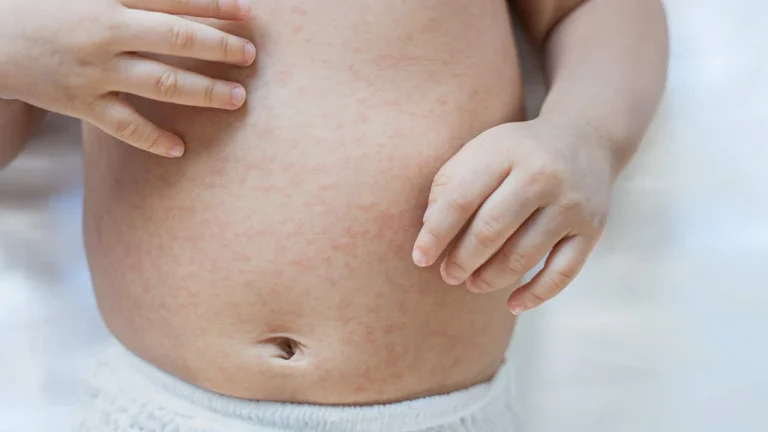 Ekcem kod dece na stomaku - Prime Medical Kids