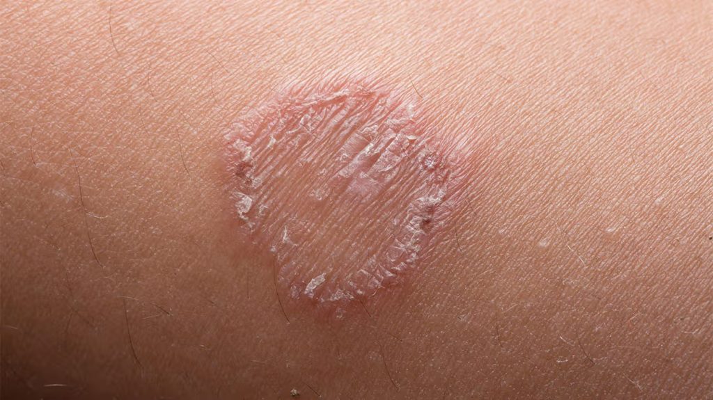 Lišaj kod dece - kako izgleda - Prime Medical Kids