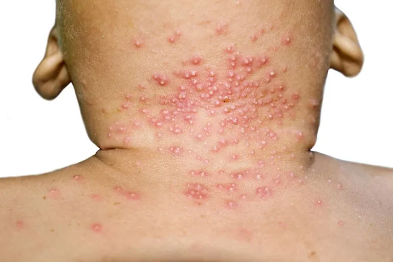 Moluske virusne bradavice kod dece