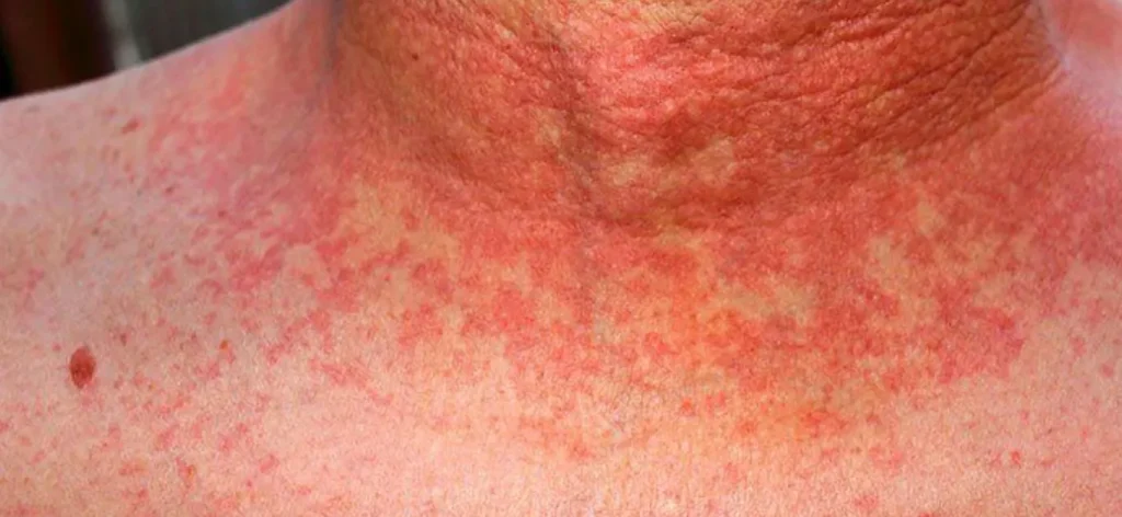 Šarlah kod dece - Prime Medical Kids